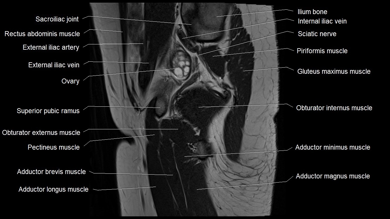 Hip sagittal cross sectional anatomy image 27.webp